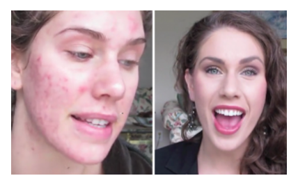 Cassandra Bankson e i suoi tutorial per coprire l'acne con il trucco