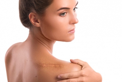I rimedi contro le cicatrici consigliati dal dermatologo - Ok Salute e Benessere