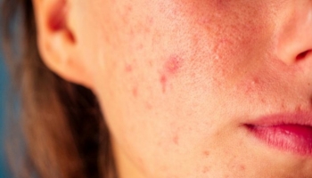 Cura dell'acne con farmaci: la beauty routine per salvare la pelle del viso