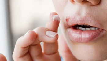 Come prevenire e trattare l'herpes labiale in estate
