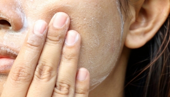 Argento e acne: perché Alusac è così efficace?